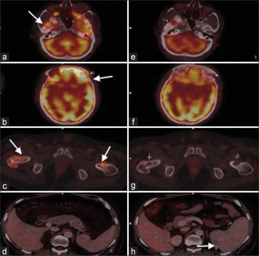 [18F]FDG- PET/CT in Diagnosis, Staging, and Management of Patients with Langerhans Cell Histiocytosis.