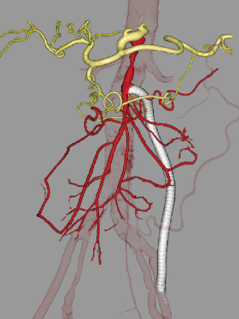 Revision Surgery for Venous Graft Stenosis of SMA Bypass.