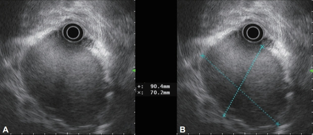 [Gastric Undifferentiated Pleomorphic Sarcoma Presenting as a Rapidly Growing Subepithelial Tumor].