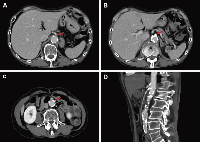 Revision Surgery for Venous Graft Stenosis of SMA Bypass.