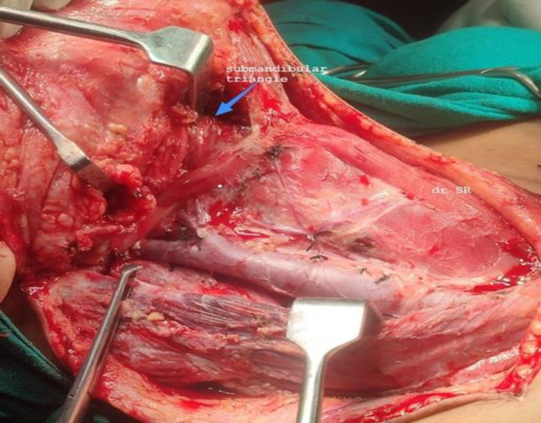 Submandibular Gland Preservation in Oral Cavity Squamous Cell Carcinomas: Our Analysis at A Tertiary Care Hospital.