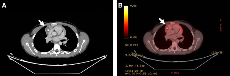 Mediastinal Tumor in a Boy With GnRH-Independent Precocious Puberty and Fluctuating β-HCG Levels.