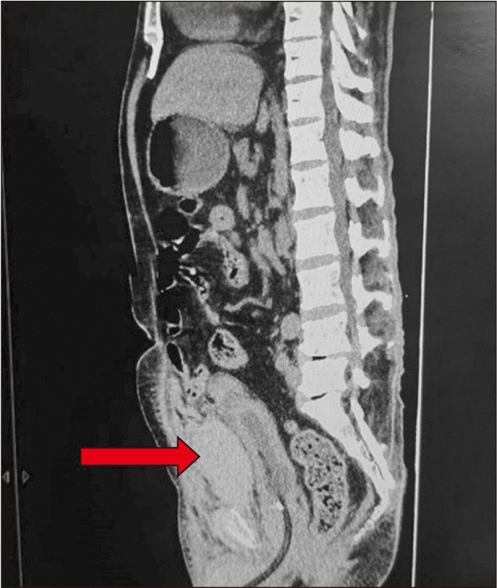 Pelvic hematoma post prostatic urethral lift: A need to be vigilant in high-risk patients.