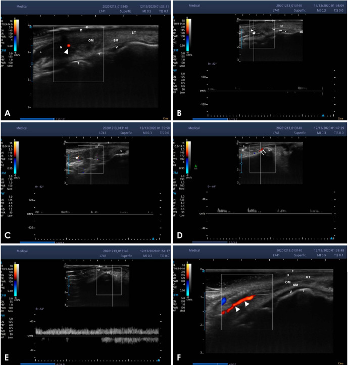 Ultrasonography in the management of lip complications caused by hyaluronic acid.