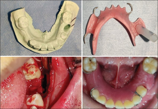 Immense potential for self-healing with conservative management of a large radicular cyst associated with pulpectomized primary tooth: A 40-month follow-up.