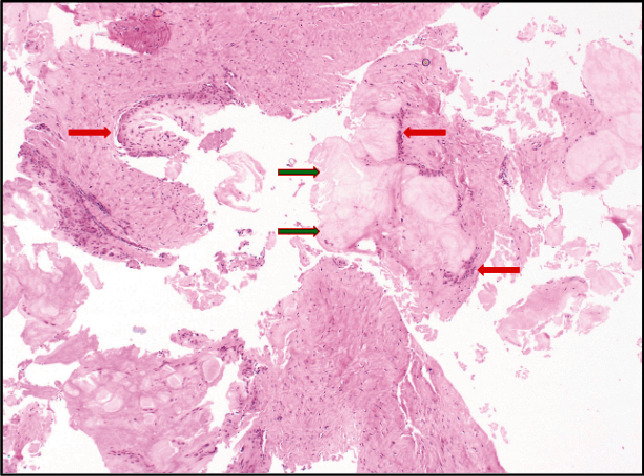 Gouty Tophi Surrounding the Nonabsorbable Sutures of an Achilles Tendon Repair Surgical Site: A Case Report.