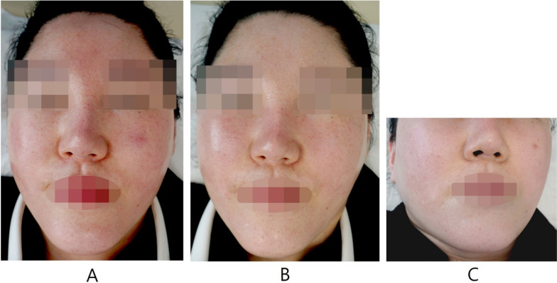 Seborrheic Dermatitis Treatment Using a Standardized Medical Insurance-Approved Korean Medicine: a case report.