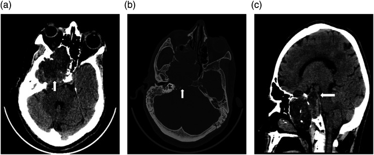 Invasive trigeminal ganglioneuroma: A case report and review of the literature.