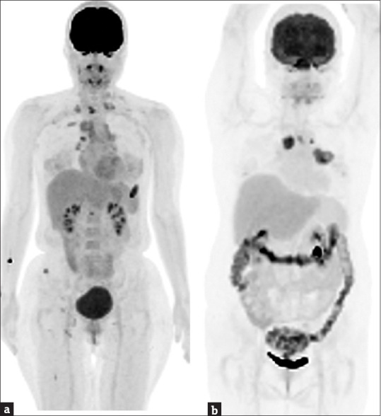 The value of <sup>18</sup>F-fluorodeoxyglucose positron emission tomography-based radiomics in non-small cell lung cancer.