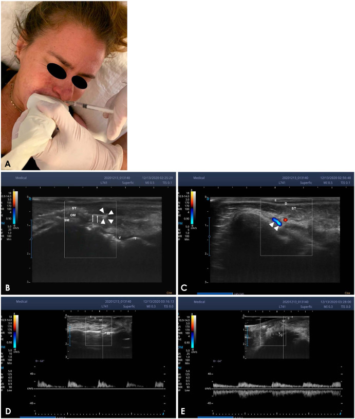 Ultrasonography in the management of lip complications caused by hyaluronic acid.