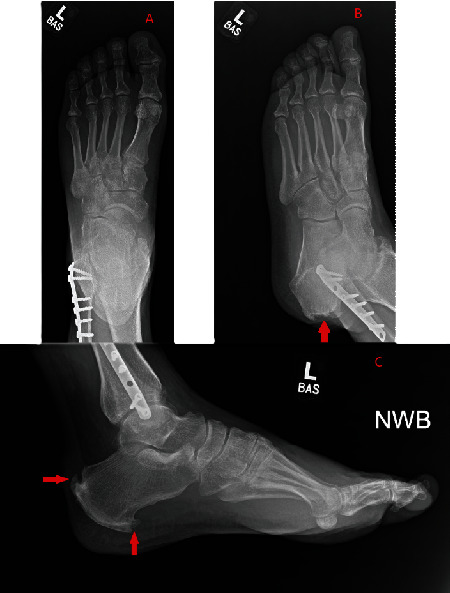 Gouty Tophi Surrounding the Nonabsorbable Sutures of an Achilles Tendon Repair Surgical Site: A Case Report.