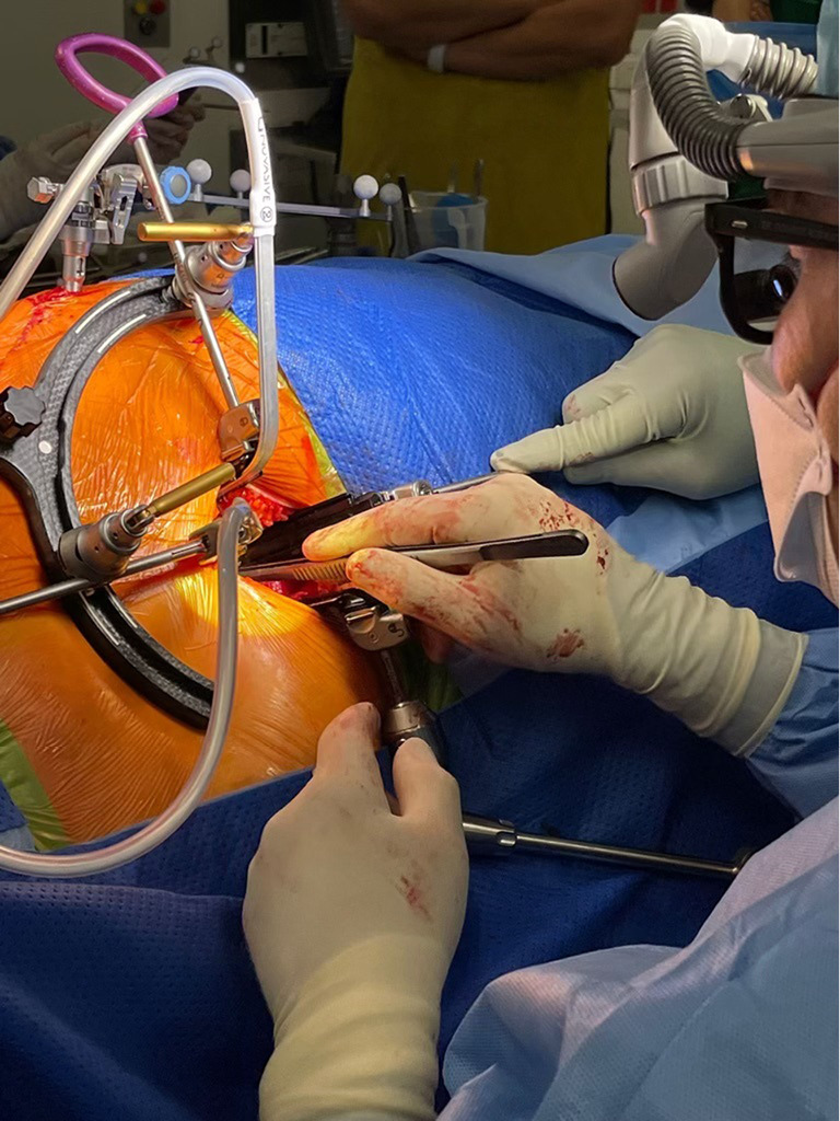 Lateral decubitus anterior exposure of the L4-5 disc maintains safety compared with supine positioning.