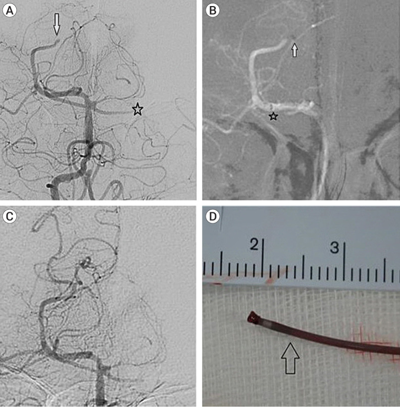 Suction thrombectomy of distal medium vessel occlusion using microcatheter during mechanical thrombectomy for acute ischemic stroke: A case series.