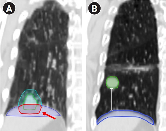 Optimizing target and diaphragmatic configuration, and dosimetric benefits using continuous positive airway pressure in stereotactic ablative radiotherapy for lung tumors.