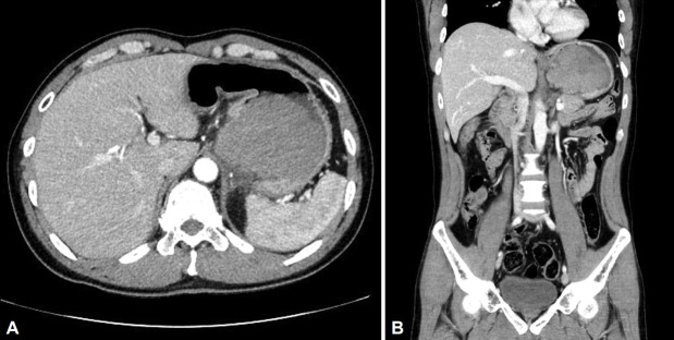 [Gastric Undifferentiated Pleomorphic Sarcoma Presenting as a Rapidly Growing Subepithelial Tumor].