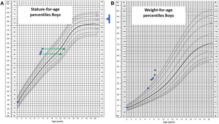 Mediastinal Tumor in a Boy With GnRH-Independent Precocious Puberty and Fluctuating β-HCG Levels.