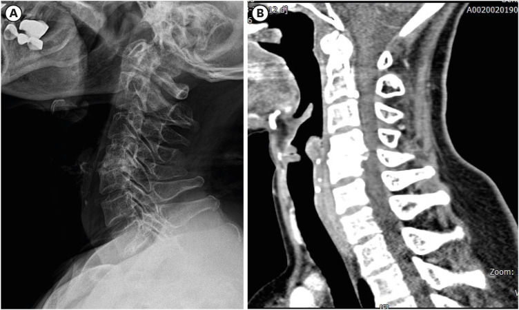 Oral Extrusion of a Screw After Anterior Cervical Spine Plating: A Case Report.