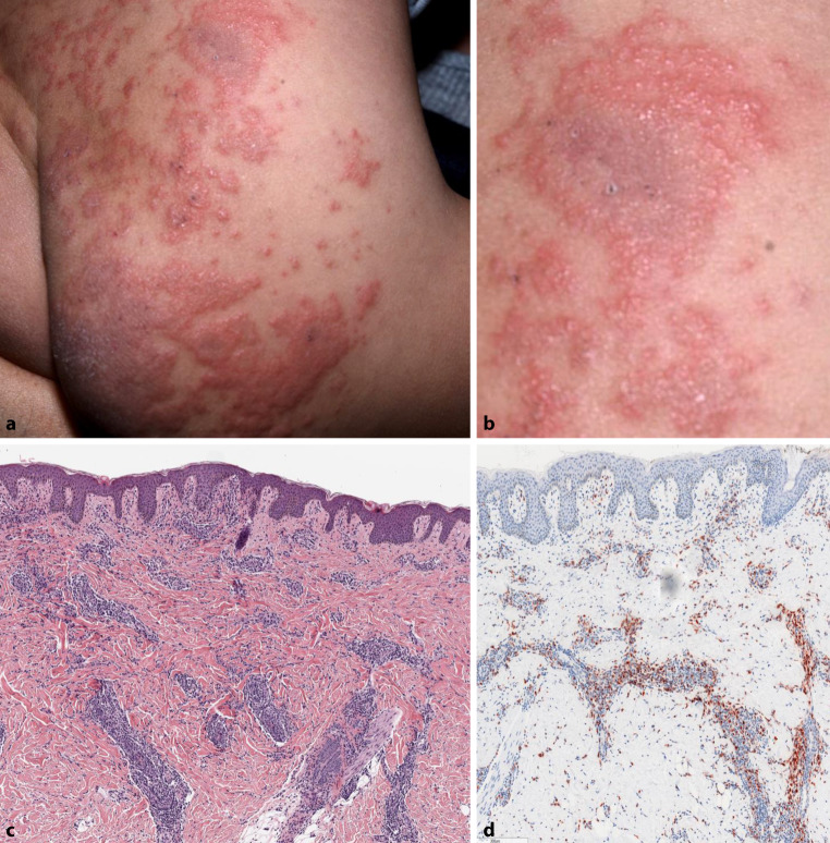 Diagnostic difficulties in pediatric annular dermatoses.