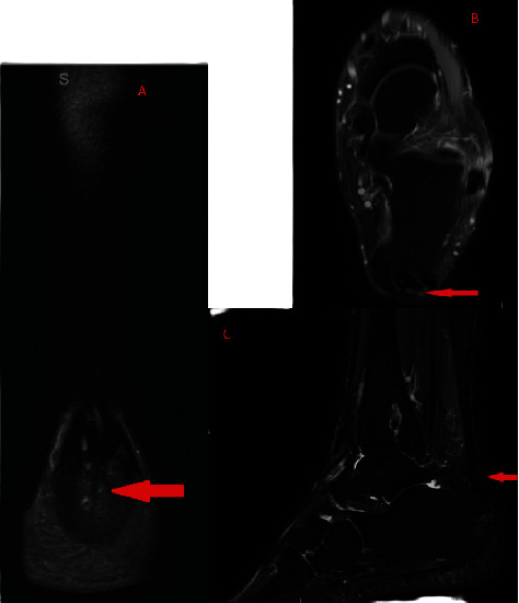 Gouty Tophi Surrounding the Nonabsorbable Sutures of an Achilles Tendon Repair Surgical Site: A Case Report.