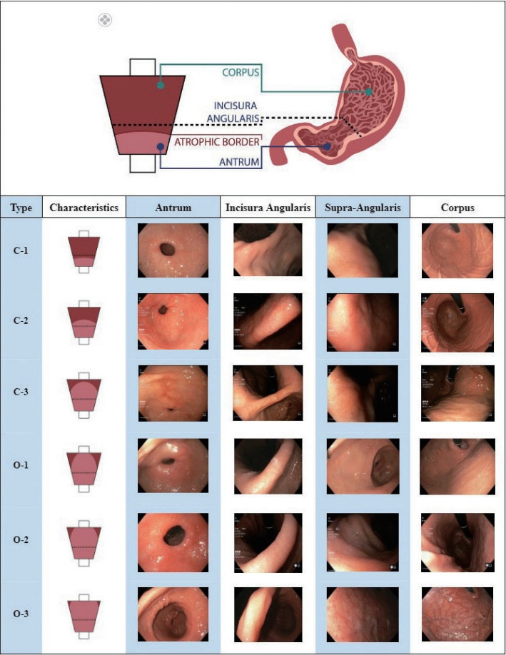 Chronic Atrophic Gastritis and Intestinal Metaplasia: A Latin American Perspective.