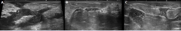 Relationship of post-treatment radiological findings with relapses in idiopathic granulomatous mastitis patients.
