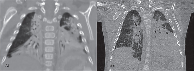 Ultra-Early Diffuse Lung Disease in an Infant with Pathogenic Variant in Telomerase Reverse Transcriptase (<i>TERT</i>) Gene.