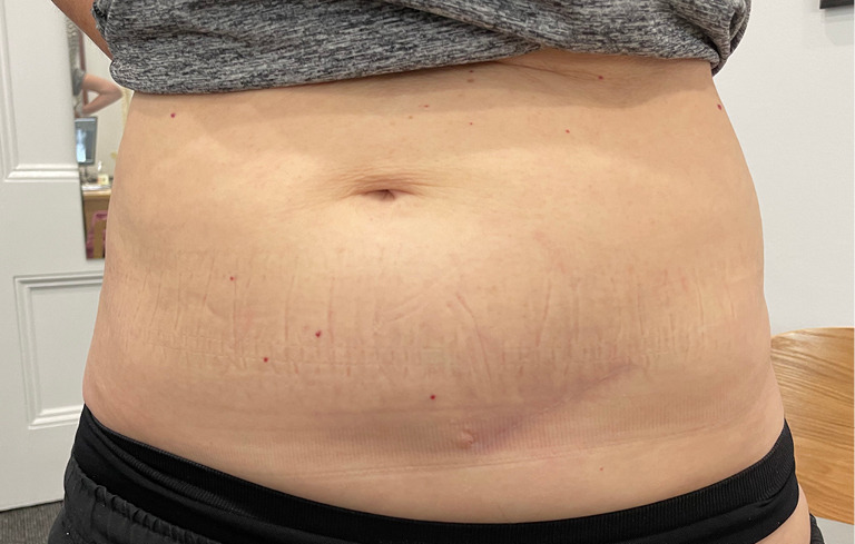 Lateral decubitus anterior exposure of the L4-5 disc maintains safety compared with supine positioning.