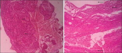 Immense potential for self-healing with conservative management of a large radicular cyst associated with pulpectomized primary tooth: A 40-month follow-up.