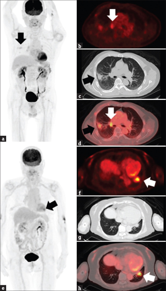 The value of <sup>18</sup>F-fluorodeoxyglucose positron emission tomography-based radiomics in non-small cell lung cancer.