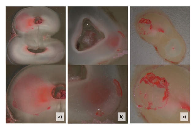 The Impact of Different Irrigation Protocols on the Bond Strength of Self-Adhesive Resin Cement to Radicular Dentin.
