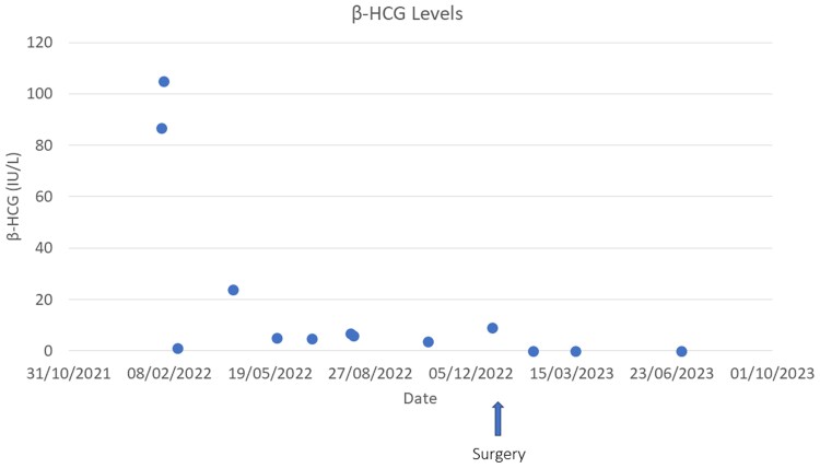 Mediastinal Tumor in a Boy With GnRH-Independent Precocious Puberty and Fluctuating β-HCG Levels.