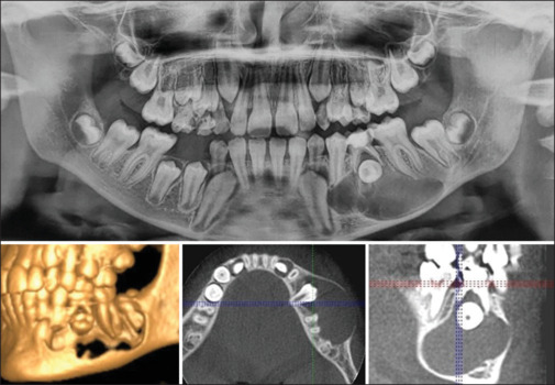 Immense potential for self-healing with conservative management of a large radicular cyst associated with pulpectomized primary tooth: A 40-month follow-up.