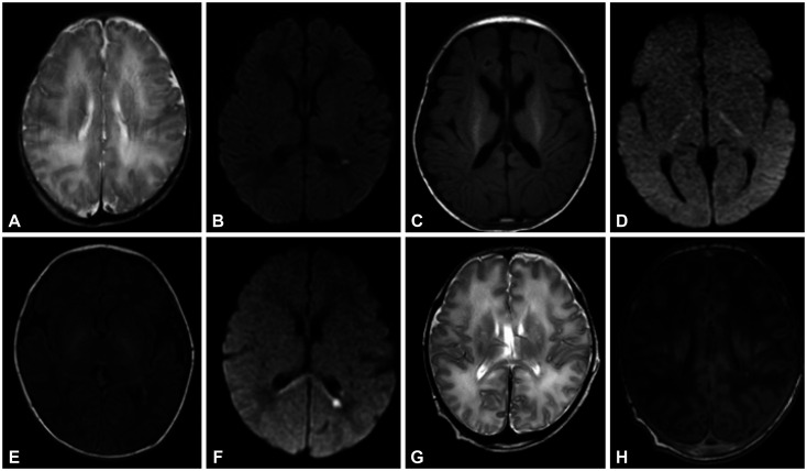 Genetic Diagnosis in Neonatal Encephalopathy With Hypoxic Brain Damage Using Targeted Gene Panel Sequencing.