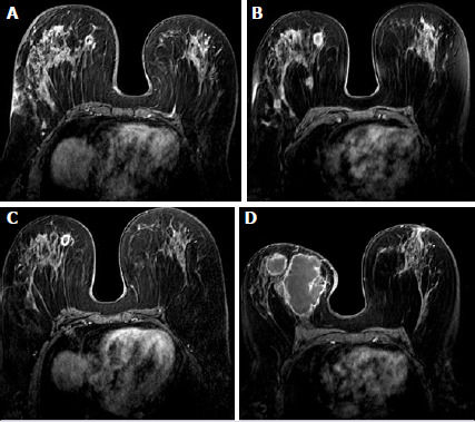 Relationship of post-treatment radiological findings with relapses in idiopathic granulomatous mastitis patients.