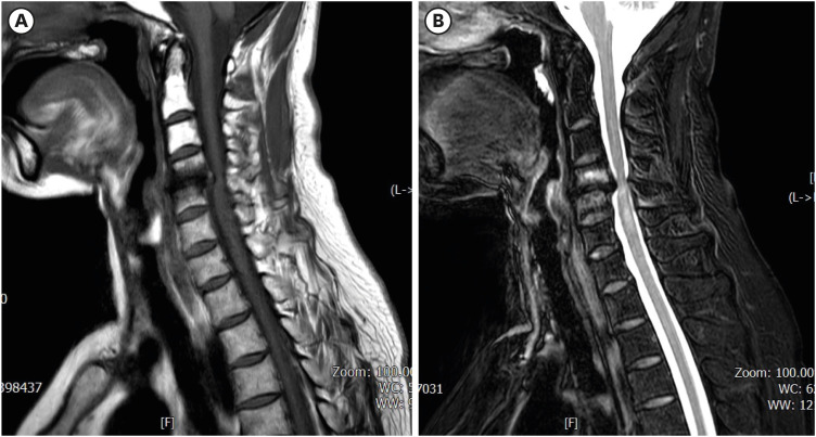 Oral Extrusion of a Screw After Anterior Cervical Spine Plating: A Case Report.
