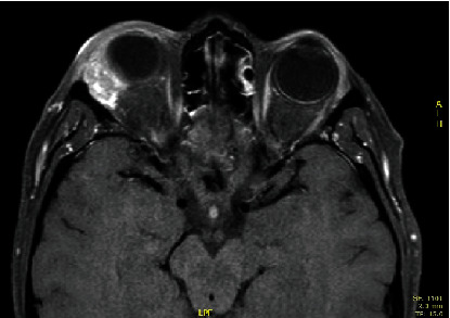 Primary Ductal Her-2 Positive Adenocarcinoma of Salivary Gland: A Long Follow-Up Case Report and Review of the Literature.