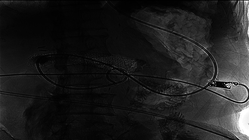 Recurrence of malignant duodenal obstruction following duodenal stenting: successful management through EUS-guided gastrojejunostomy (with videos).