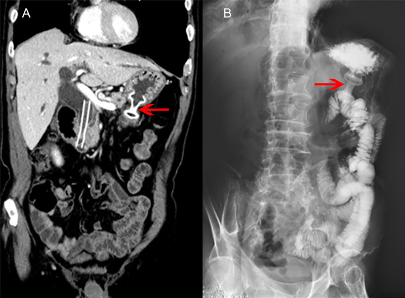 EUS-led breakthrough: An innovative journey to overcome complete gastric outlet obstruction by gastroenterostomy (with video).