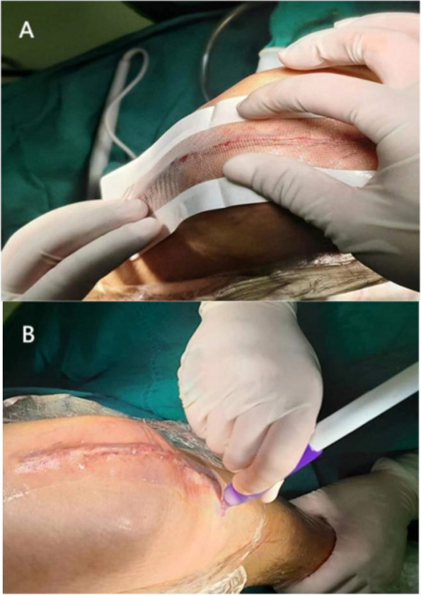 Comparison of the safety and efficacy of three superficial skin closure methods for multi-layer wound closure in total knee arthroplasty: a multicenter, prospective, randomized controlled trial.