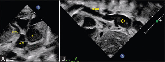 Systemic artery aneurysms - A marker of high-risk Kawasaki disease.
