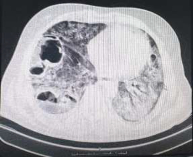 COVID-19 associated lung cavitary lesions: A case series.