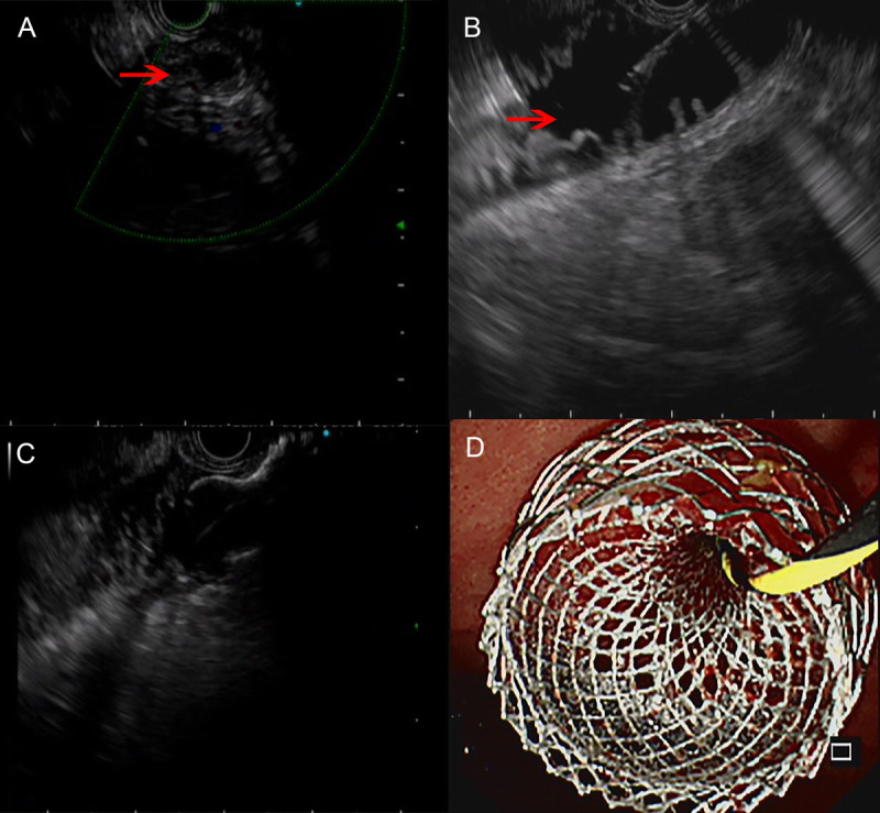 EUS-led breakthrough: An innovative journey to overcome complete gastric outlet obstruction by gastroenterostomy (with video).