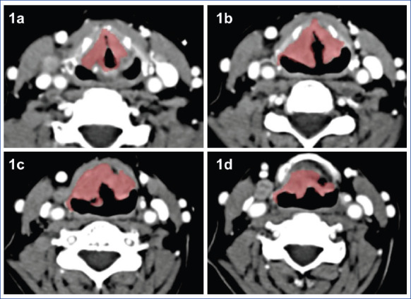 Predictors of Cervical Lymph Node Metastasis in Patients with Squamous Cell Carcinoma of the Larynx.