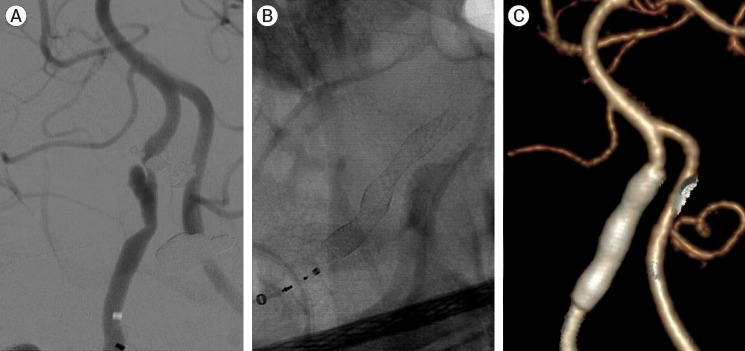 Multiple telescopic stenting versus single flow diverter for the treatment of vertebral artery dissecting aneurysm.