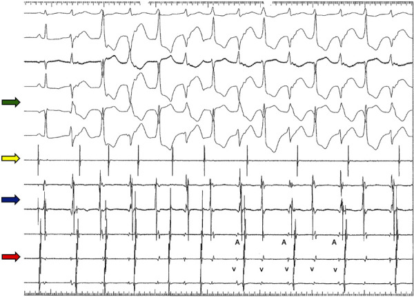 [Andersen-Tawil Syndrome, a differential of bidirectional ventricular tachycardia: a case report].