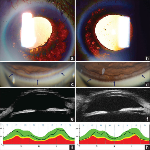 Bilateral Acute Iris Transillumination Following Coronavirus Disease 2019 Infection.
