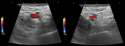 Arteriovenous Fistula Simulating Deep Vein Thrombosis Following Lumbar Arthrodesis.