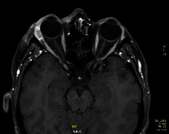 Primary Ductal Her-2 Positive Adenocarcinoma of Salivary Gland: A Long Follow-Up Case Report and Review of the Literature.