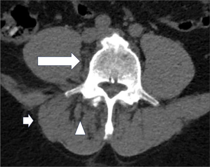 Facet joint septic arthritis: A review of cases.