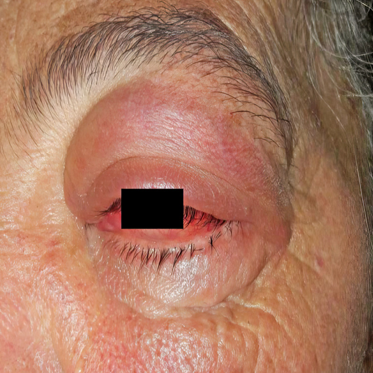 Orbital Masses in Granulomatosis with Polyangiitis: A Call for Clinical Vigilance.
